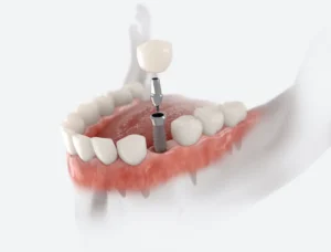 What Happens During a Dental Implant Procedure? in Rockville, MD
