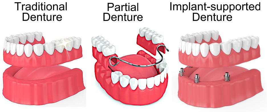 Traditional denture vs. Implant-supported denture